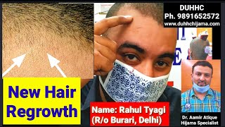 Visible👴👉👨Result in Hair RegrowthHijama Results for Hair Loss Hijama Hair TreatmentHijama Reviews [upl. by Eilrebmik]