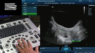 Hot Tips  Measuring the Endometrium [upl. by Littell]