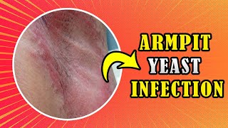 How to treat Armpit yeast infection Candida at home [upl. by Pearson]