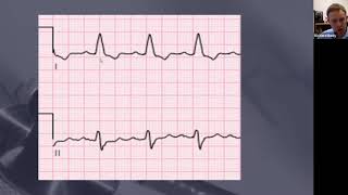 ECG in a Minute LBBB and LAD [upl. by Eednar937]