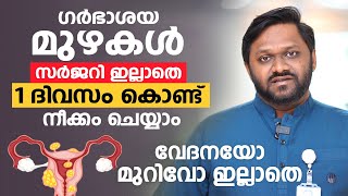 ഗർഭാശയ മുഴകൾ വേദനയോ മുറിവോ ഇല്ലാതെ നീക്കം ചെയ്യാം  Uterine Fibroid Embolization  Dr Salal [upl. by Nedarb]