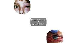 Preseptal cellulitis vs Orbital cellulitis causes signssymptoms treatment Explained 👁️ [upl. by Miett]