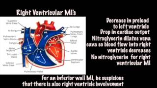 Tintinallis Emergency Medicine 8th edition video  ECG Right Ventricular MI [upl. by Fields]