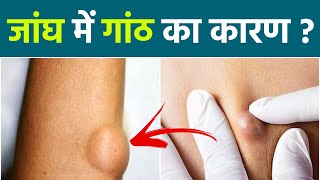 जांघ में गांठ होने के कारण Hernia Symptoms  Jangh Me Gath Hona  Jangh Me Ganth Ka Ilaj  Boldsky [upl. by Kiran]