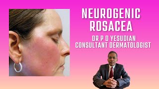 Neurogenic rosacea [upl. by Aliuqehs]