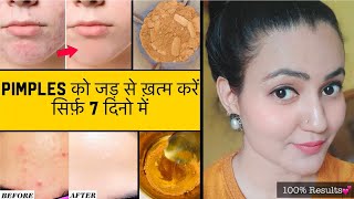 In 7 Days 💕 PIMPLES को जड़ से खत्म करें सिर्फ 7 दिनों में और पाए बेदाग़ Spotless Glowing Skin 100 [upl. by Kelcy]