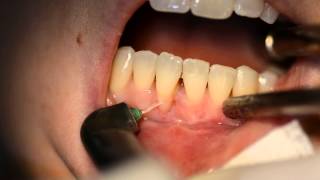 Root Surface modification using ErCrYSGG laser [upl. by Nairam]