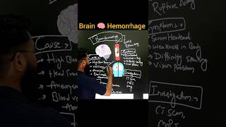 Brain 🧠 Hemorrhage🩸💉 brain hemorrhage medical radiology science shorts shortfeed love [upl. by Hannon]