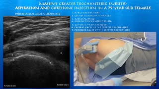 Ultrasound Guided Massive Greater Trochanteric Bursitis Aspiration and Injection by probeultrasound [upl. by Ludly]