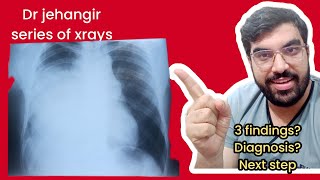 CHEST XRAY OF OPACITY IN RIGHT LUNGXRAY OF PNEUMONIAXRAY OF LUNG CANCERMASS ON CHEST XRAYNEET PG [upl. by Eissert]