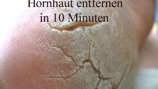 Hornhaut entfernen  Beste und schnellste Methode [upl. by Llirrehs677]