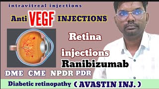 Anti vegf injections  avastin injections  Ranibizumab injections  Bevacizumab injections  vegf [upl. by Auqinehs]