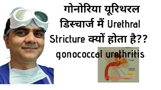 मूत्रमार्ग निंदा urethral stricture Kyun Hota haiGONOCOCCAL URETHRITIS URETHRAL DISCHARGE [upl. by Kcub975]