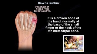 Boxers Fracture  Everything You Need To Know  Dr Nabil Ebraheim [upl. by Ahsiad890]