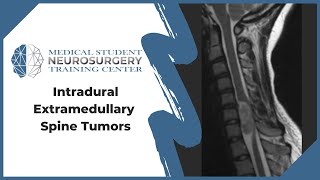 Intradural Extramedullary Spine Tumors [upl. by Llenel]