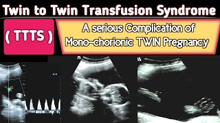 TTTS  Twin to Twin Transfusion Syndrome Ultrasound  A Serious COMPLICATION [upl. by Allain697]