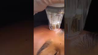 Potenza RF Microneedling at SEV Laser Chicago [upl. by Tereb]