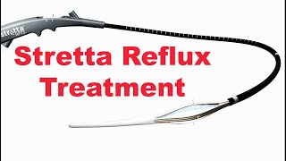 Stretta Incisionless Procedure to Treat Reflux GERD [upl. by Joete]