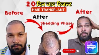 Hair Transplant Shedding Phase  After hair transplant shedding phase  shedding phase time table [upl. by Karlen840]