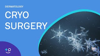 Cryo Surgery Procedure Freezing [upl. by Zubkoff]