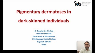 Pigmentary Dermatosis in dark skinned individuals  Dr Balachandra Ankad [upl. by Nnylamme]