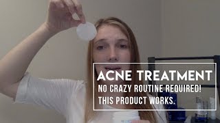 Acne Treatment That Works Review of ZO Skin Health Complexion Renewal Pads [upl. by Nils]