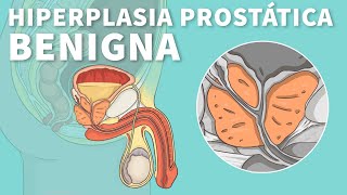 Hiperplasia prostática benigna Causas síntomas y tratamiento HPB  Stanford [upl. by Cobbie]