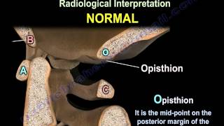 Occipitocervical Dislocation  Everything You Need To Know  Dr Nabil Ebraheim [upl. by Urien604]