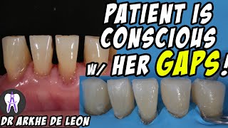 Closing The Patients Gaps with Direct Composite Technique C24 [upl. by Elwira73]