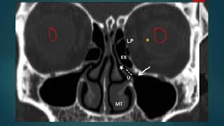 OSTEOMEATAL COMPLEX UNIT OMC ON CT ANATOMY SIMPLIFIED [upl. by Aivatnohs210]