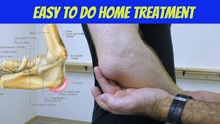 Elbow Bursitis Treatment at Home  How to Treat Olecranon Bursitis [upl. by Ginni]