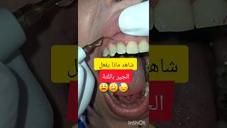 جير الاسنان سبب التهاب لثة شديد dentist stitch اكسبلور stitchfan ترند stitchlover dentistry [upl. by Adnawot247]