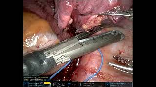 Left Basilar Segmentectomy after Wedge [upl. by Teerell]