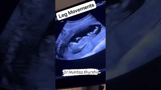 Ultrasound scan in pregnancy [upl. by Boris187]