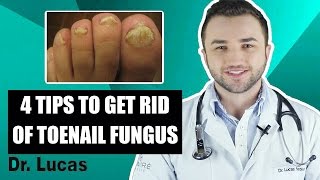 4 Tips to get rid Toenail Fungus  Dr Lucas Fustinoni Brazil [upl. by Rodgiva]