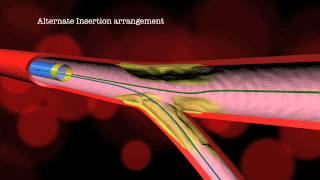 Dedicated Bifurcation Stenting and Alternative Deployment [upl. by Emily]