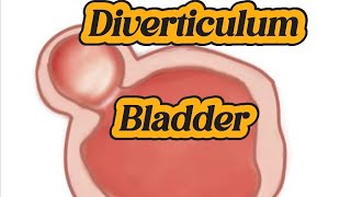 Bladder Diverticulum  Cystitis  Debris [upl. by Leunammi]