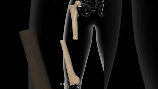 4 Most Painful Femur Shaft Fractures [upl. by Sillek]