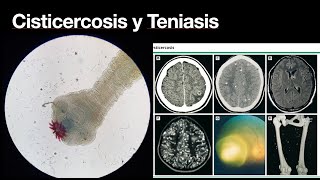 Cisticercosis y Teniasis intestinal  Conoce la enfermedad  Parasitos [upl. by Uchida548]