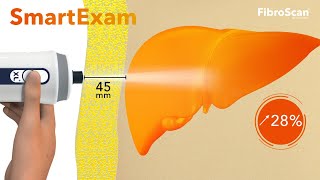 SmartExam enhances FibroScan® capabilities for improved management of fatty liver patients [upl. by Einahpet626]