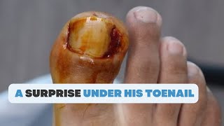 WHAT IS THIS SURPRISE UNDER HIS TOENAIL [upl. by Sera]