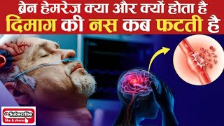 Brain Hemorrhage क्या है  ब्रेन हेमरेज कैसे होता है  जानिए ब्रेन हेमरेज के लक्षण कारण और बचाव [upl. by Atelra]