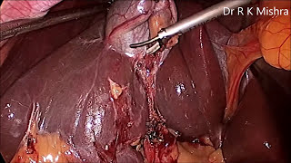 Gallbladder Stone Surgery [upl. by Analak]