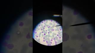 Acute lymphocytic leukemia medicoaanchal03 shorts biology pathology neet mbbs microscope [upl. by Norrab]