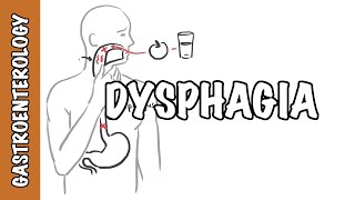 Approach to dysphagia difficulty swallowing  causes pathophysiology investigation [upl. by Darrel]