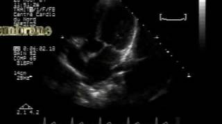 subaortic membrane and VSD 22 [upl. by Wiltshire]