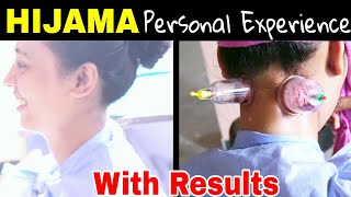 My Personal Experience of Hijama with Results sharing [upl. by Hartwell485]