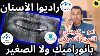 راديو بانوراميك PANORAMIQUE راديو صغير تغليف الاسنان قتيل العرق فيكس كنوبس سنيسيس امو CNOPS AMO CNSS [upl. by Ttayh]