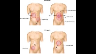 Why there would be Referred pain of Appendicitis to the right iliac fossa [upl. by Feeley]