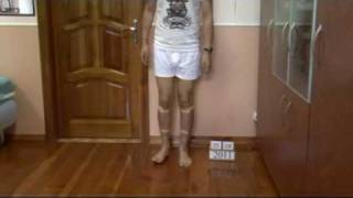 Bow legs correction treatment  China patient experience [upl. by Eriha]